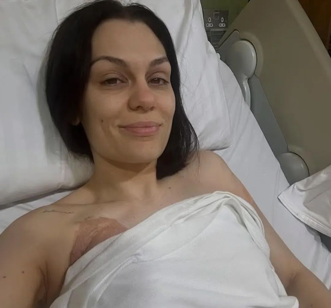 “结石姐”Jessie J分享乳腺癌术后照片:病容憔悴